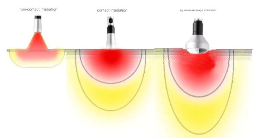 laser treatment for pain