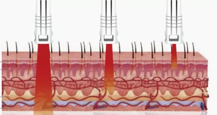 high intensity laser therapy